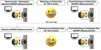Reduced interocular suppression after inverse patching in anisometropic amblyopia