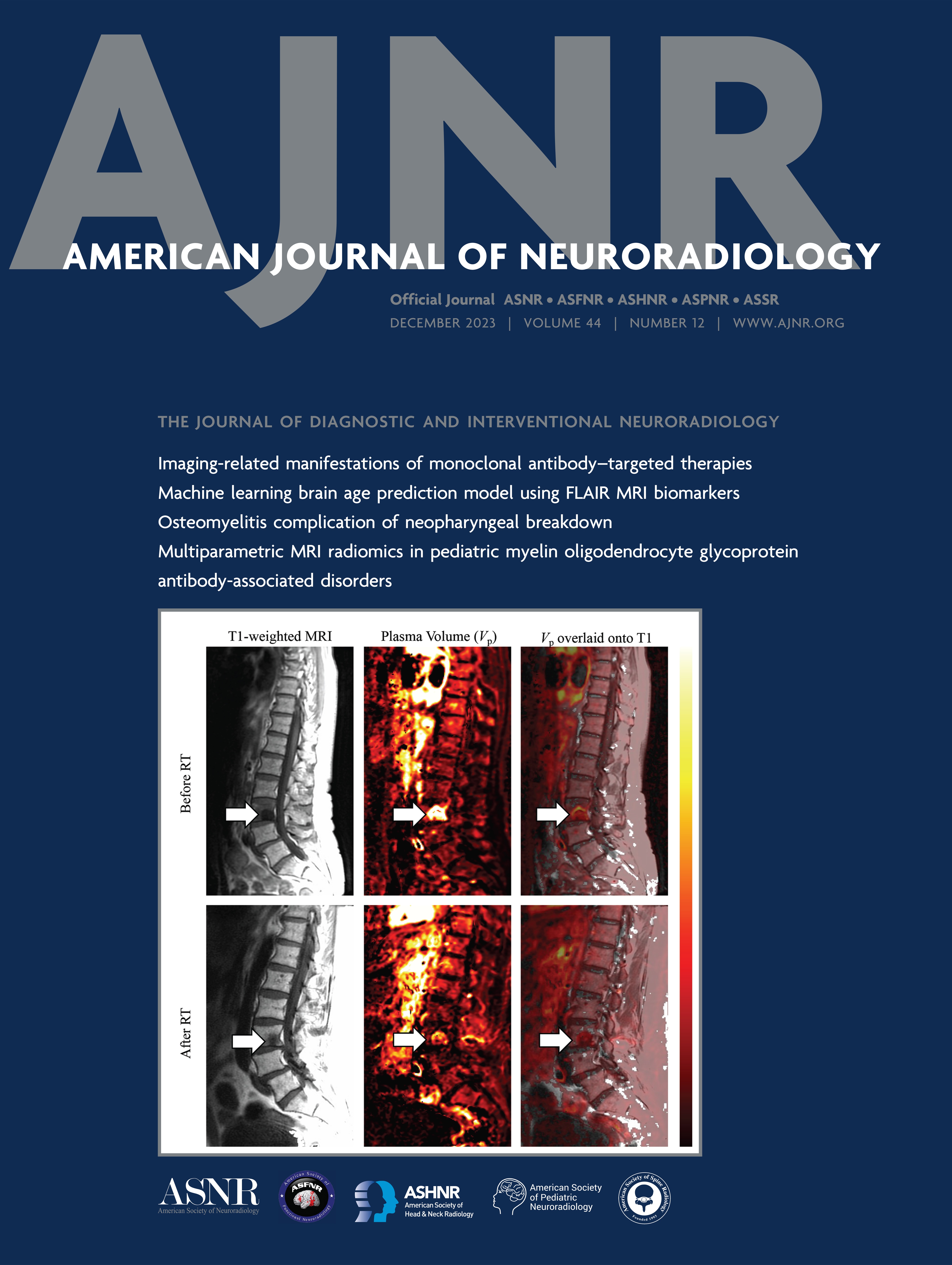 Brain Age Estimation on a Dementia Cohort Using FLAIR MRI Biomarkers [ARTIFICIAL INTELLIGENCE]