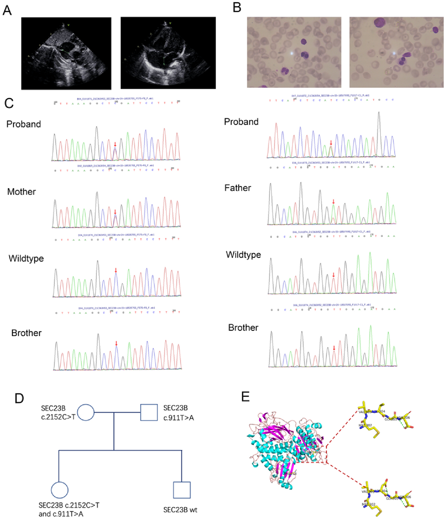 Congenital dyserythropoietic anemia type II in a newborn with a novel compound heterozygous mutation in the SEC23B: a case report and review of the literature