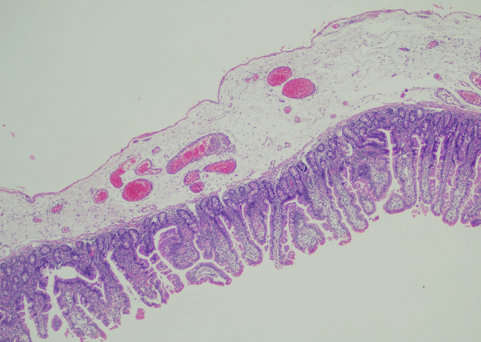 A Rare Cause of Acute Abdomen in Children: Segmental Absence of the Intestinal Musculature, a Case Report and Literature Review
