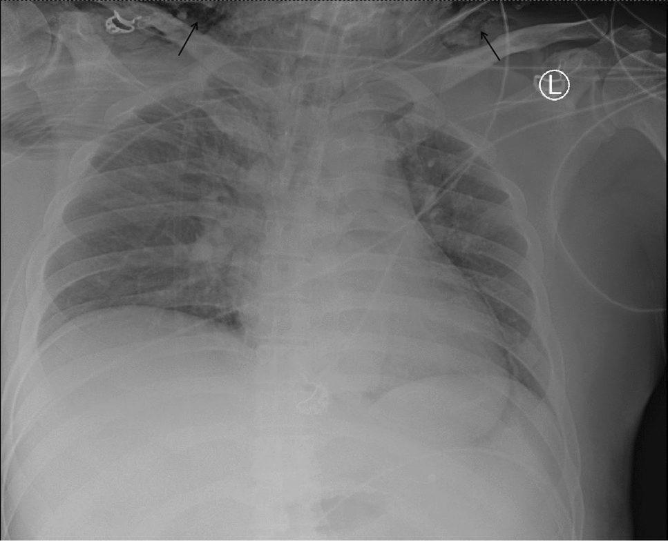 Subcutaneous emphysema potentially caused by tracheostomy tubes with subglottic suction devices