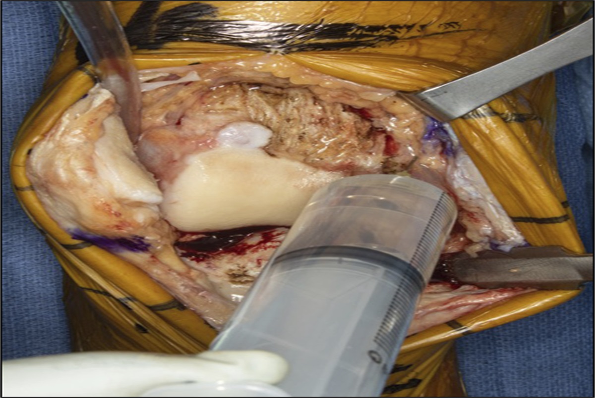 Posteromedial Periarticular Injection in Total Knee Arthroplasty: A Cadaveric Study