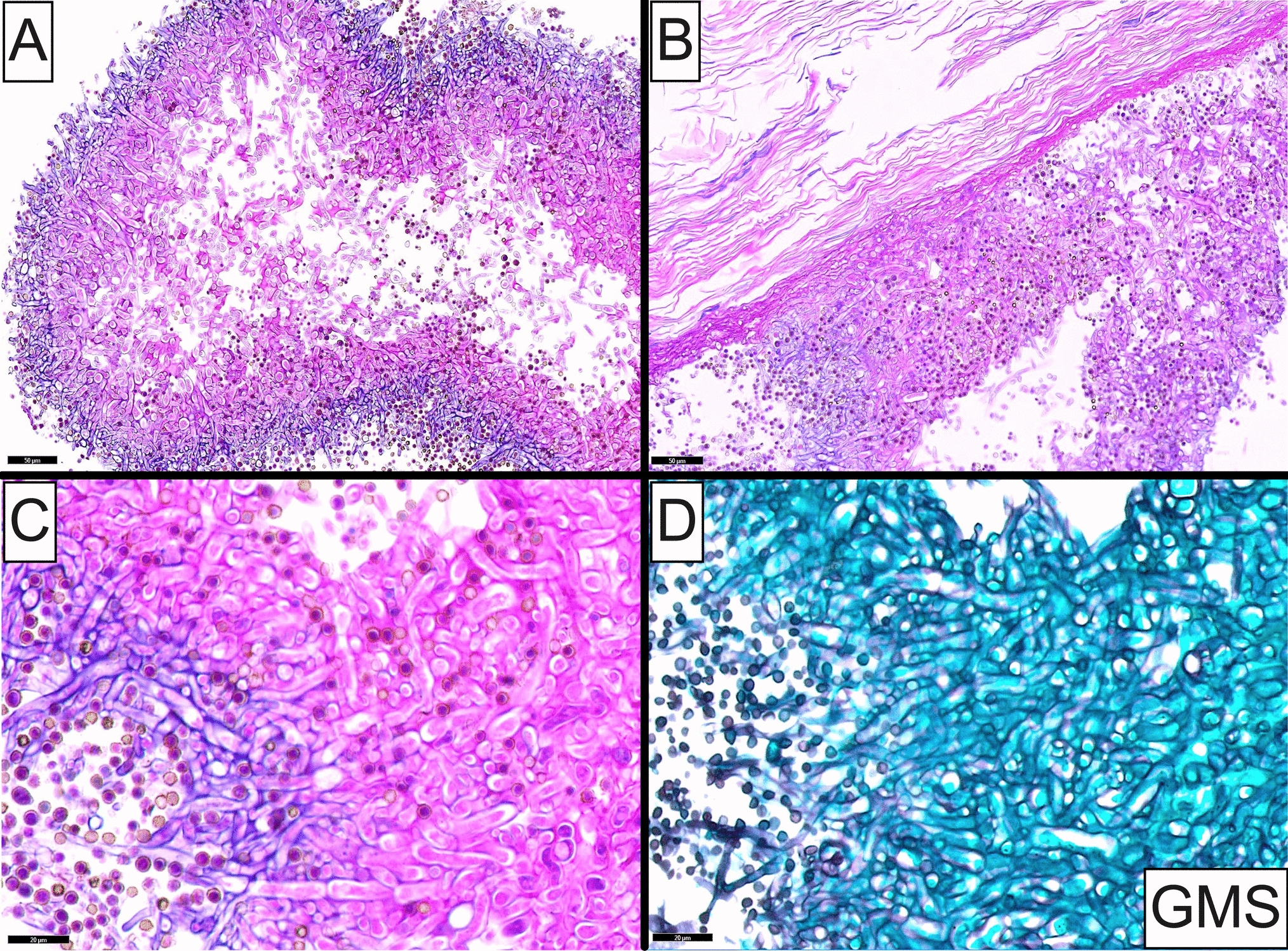 Fungal Otitis Externa (Otomycosis) Associated with Aspergillus Flavus: A Case Image