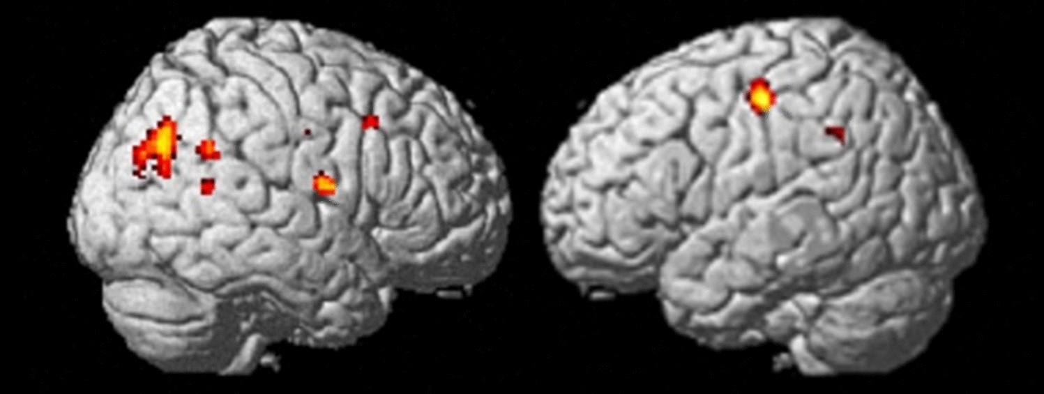 More than fear? Brain activation patterns of dental phobic patients before and after an exposure-based treatment