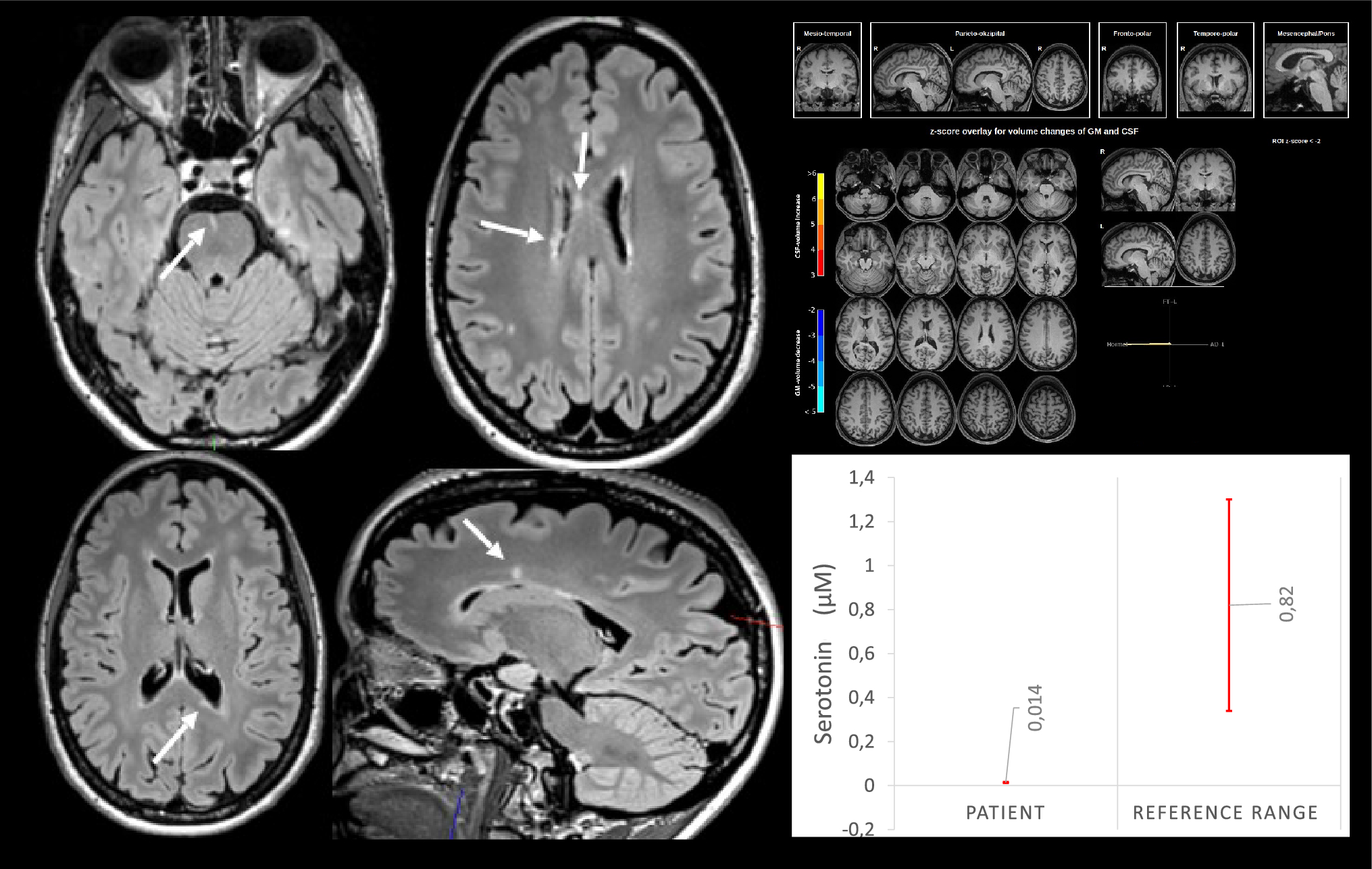 Obsessive–compulsive symptoms and brain lesions compatible with multiple sclerosis