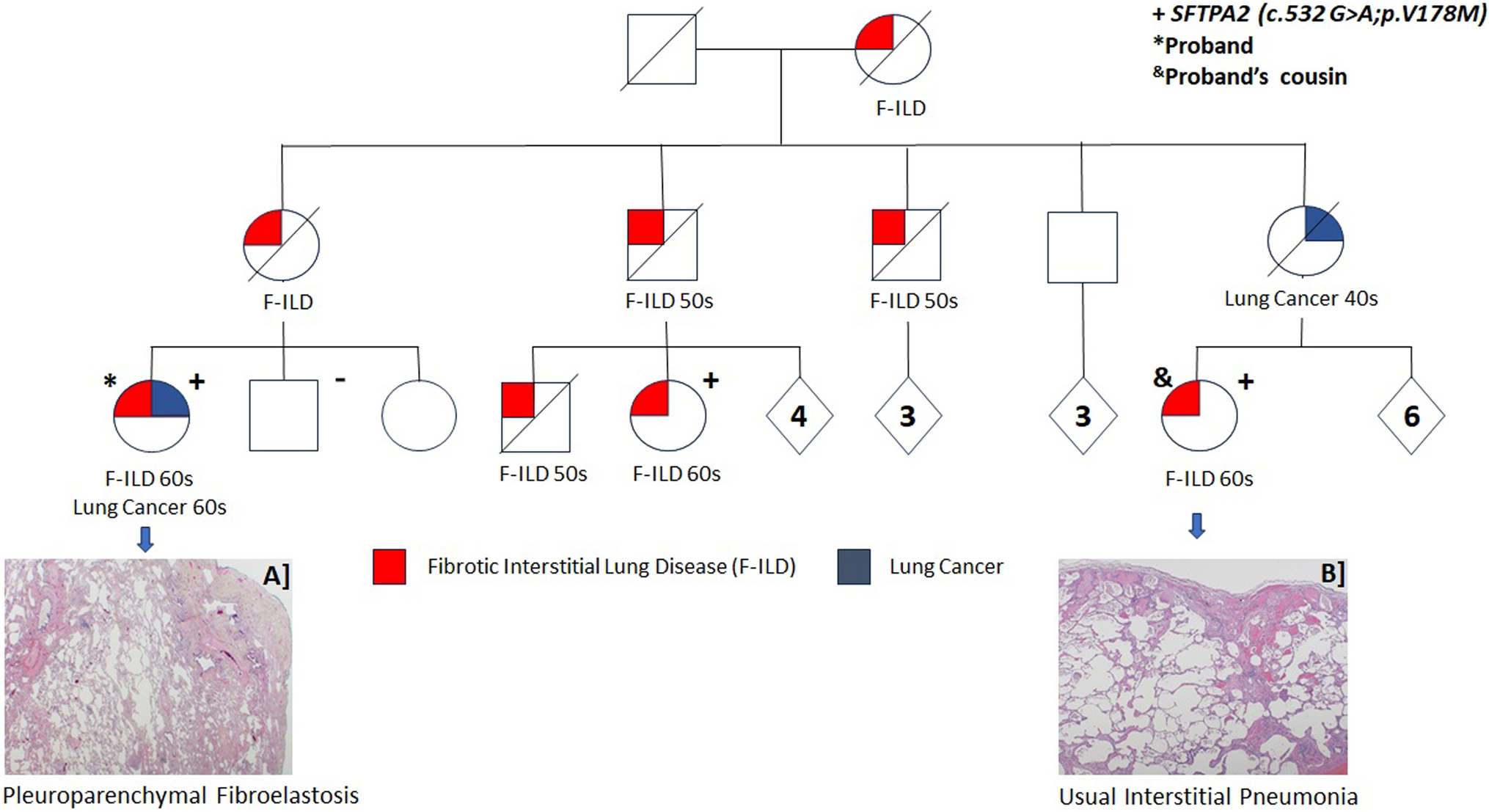 Genetic Testing Goes Beyond Imaging and Histological Evaluation in Pleuroparenchymal Fibroelastosis