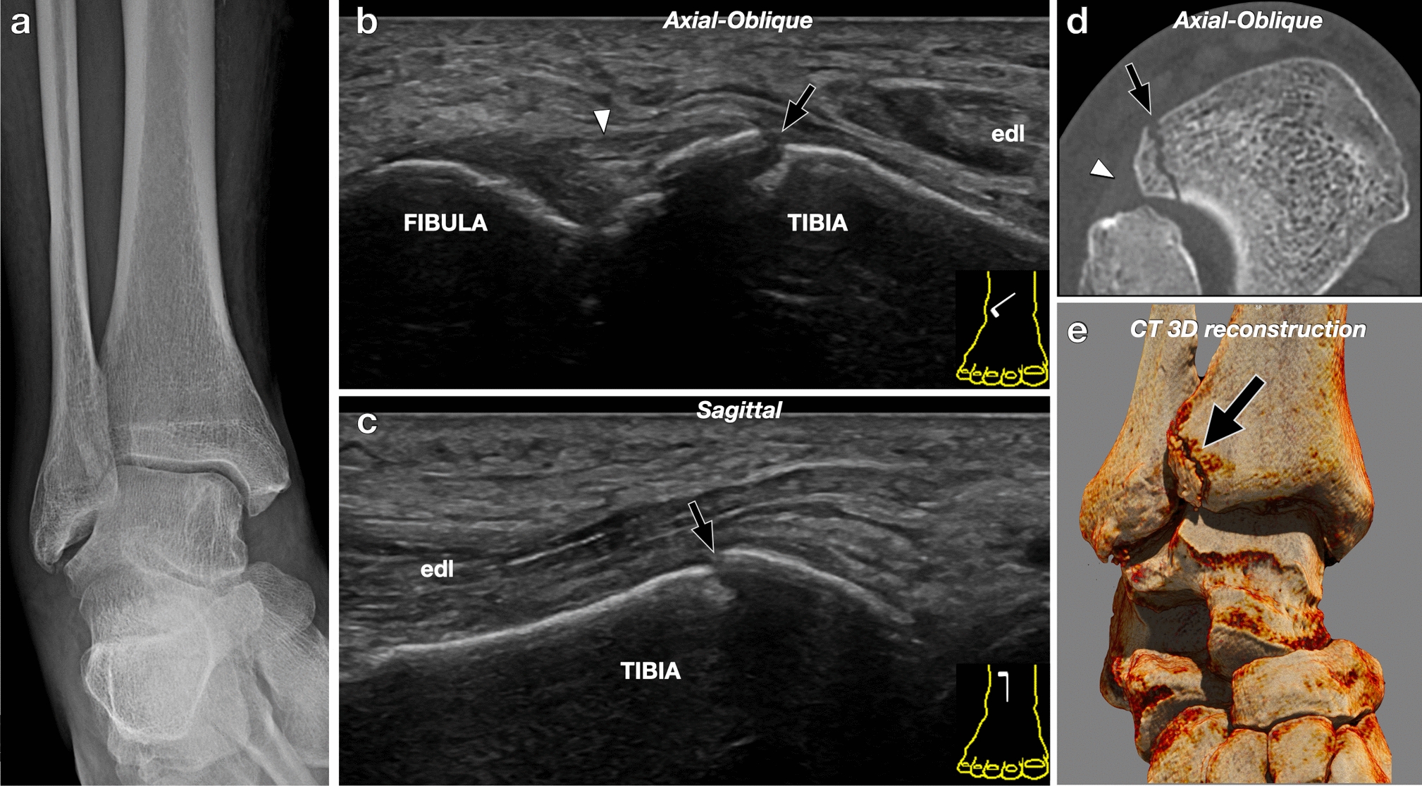Isolated Tillaux fracture of the ankle in an adult. Sonographic diagnosis of a rare injury