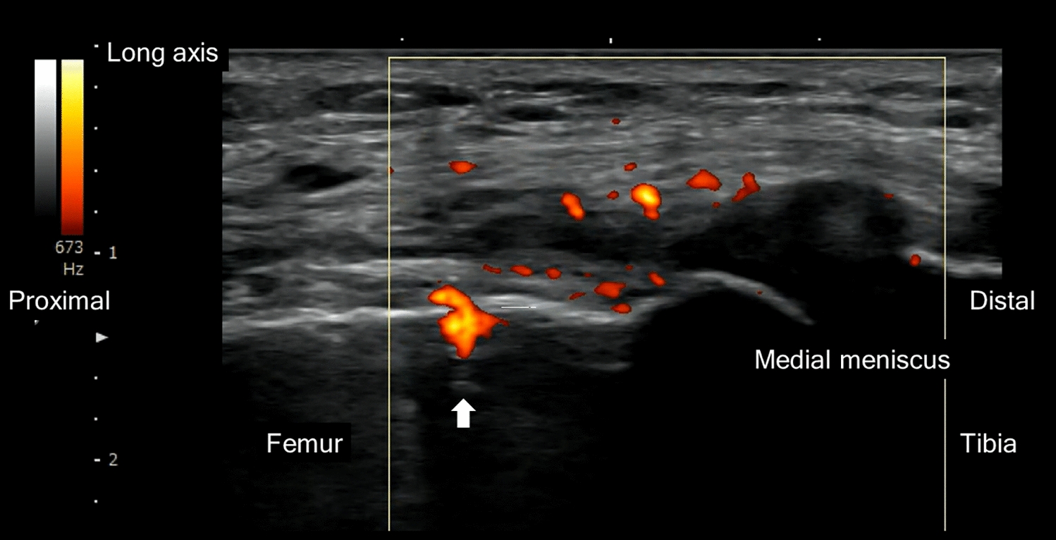 Blood flow signals through the bone cortex on ultrasonography can be used as a screening test for detecting bone marrow lesions on magnetic resonance imaging in patients with early knee osteoarthritis