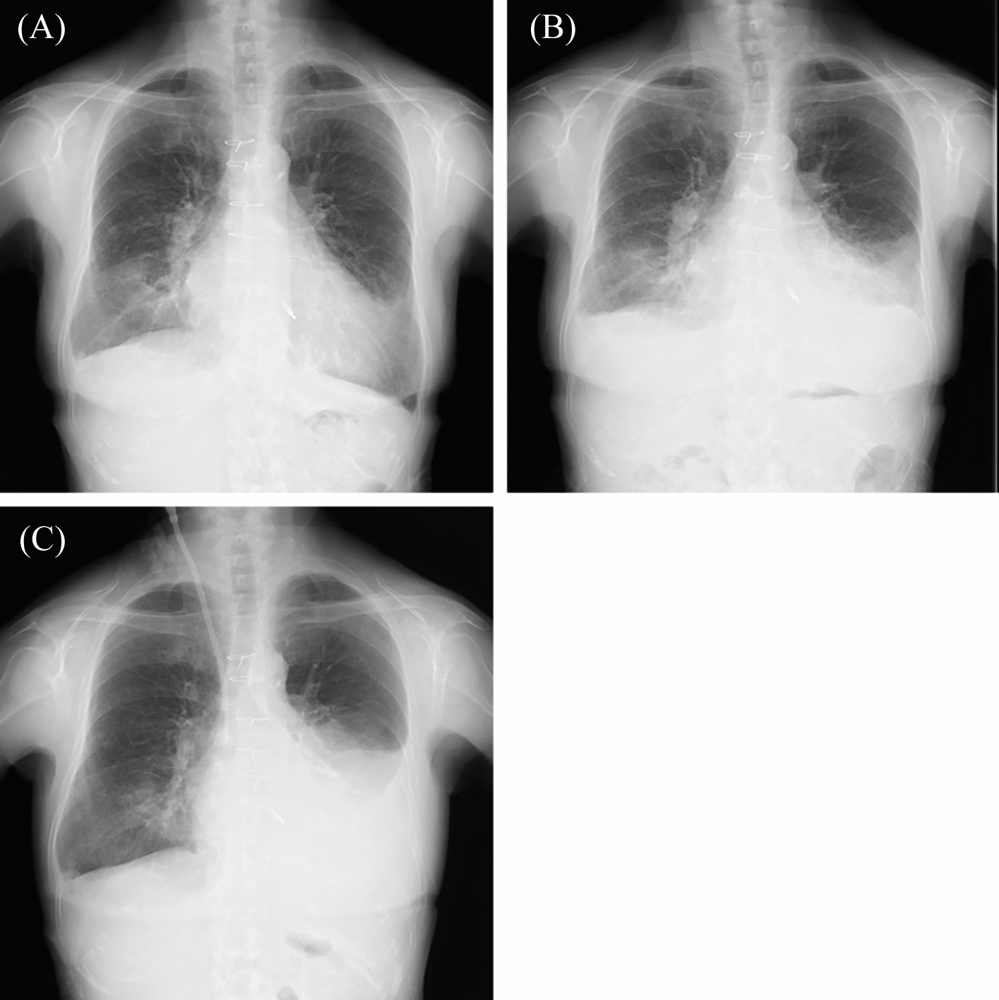 A case of a peritoneal dialysis patient with left pleuroperitoneal communication caused by a pericardial defect after coronary artery bypass surgery
