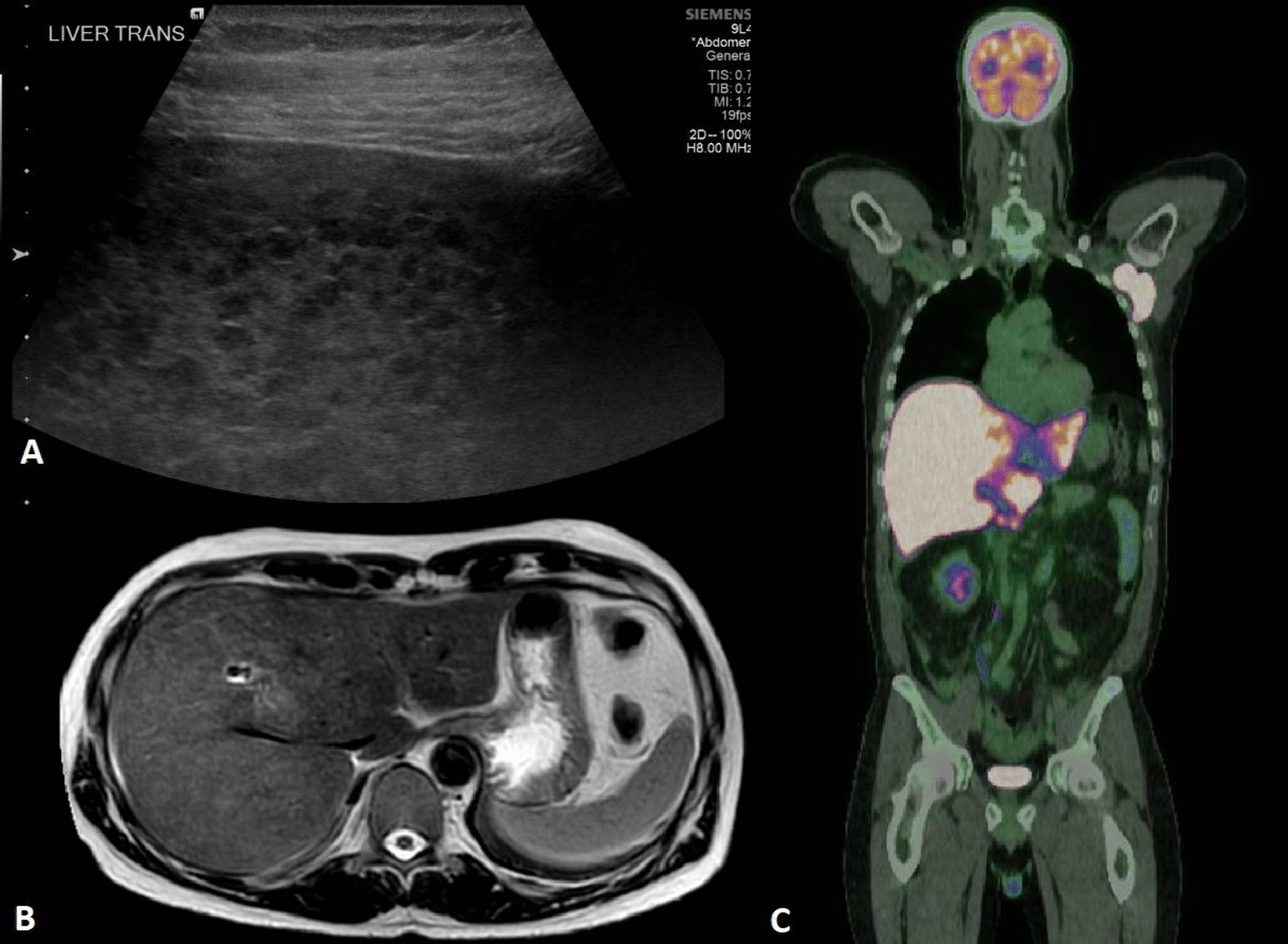 Metastatic melanoma: an unexpected cause of acute liver failure