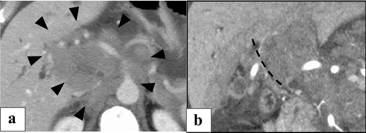 Portal vein stenting blocked the inflow tract and completely resolved bile duct varices, formed by cavernous transformation of the portal vein