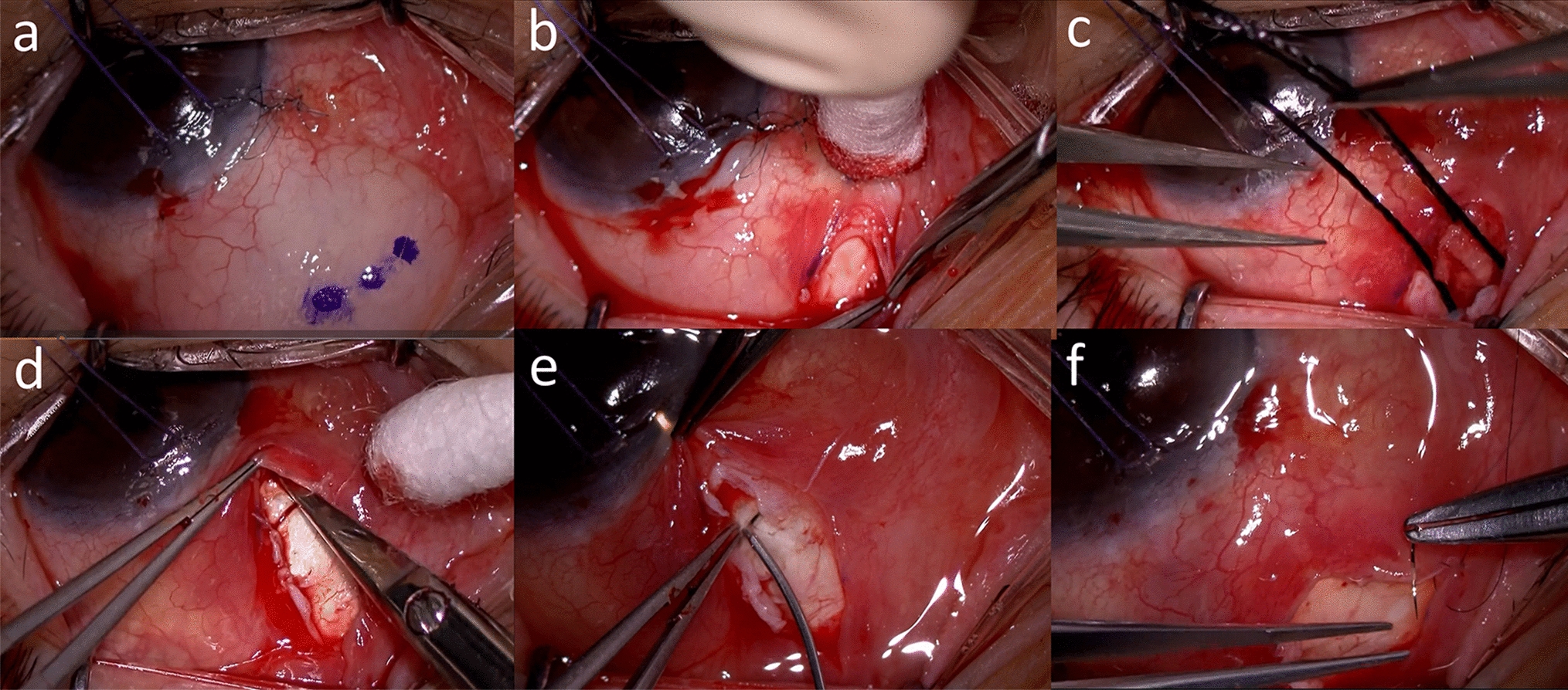 Three-year outcomes of surgical bleb revision with mitomycin C for early scarring bleb after trabeculectomy