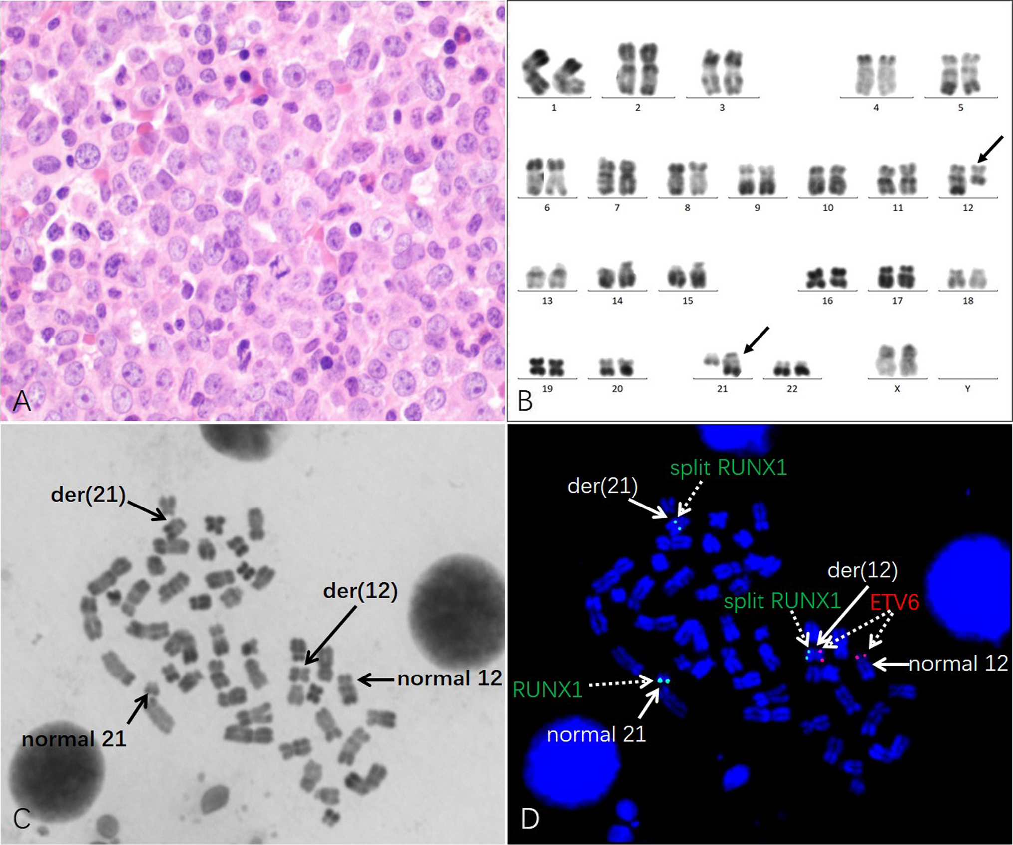 WNT inhibitory factor 1 (WIF1) is a novel fusion partner of RUNX family transcription factor 1 (RUNX1) in acute myeloid leukemia with t(12;21)(q14;q22)