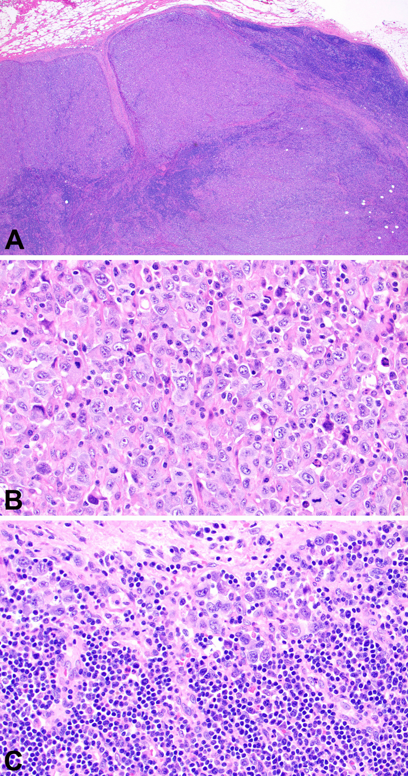 Systemic ALK-negative anaplastic large cell lymphoma with NPM1::TYK2 rearrangement