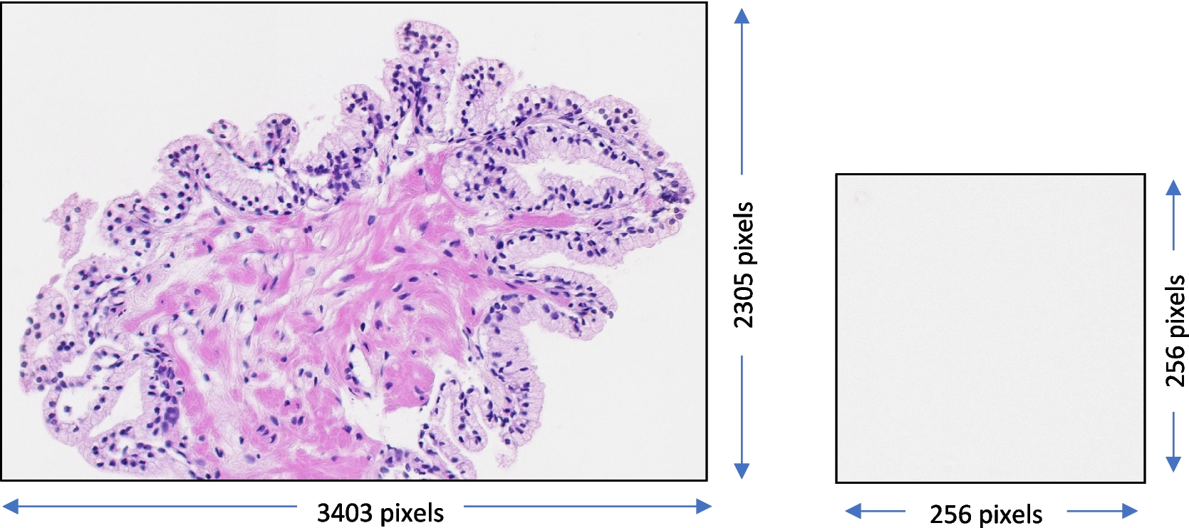 An Artificial Intelligent System for Prostate Cancer Diagnosis in Whole Slide Images