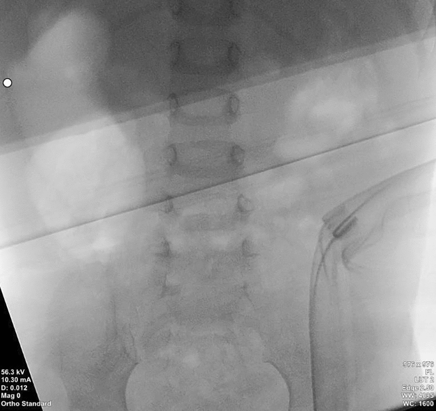 Lumbar Sympathetic Block to Treat CRPS in an 18-Month-Old Girl: A Breaking Barriers Case Report and Review of Literature
