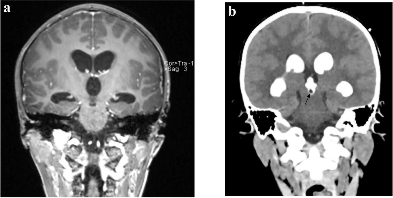 Pineal germinoma diagnosed by iohexol CT ventriculography