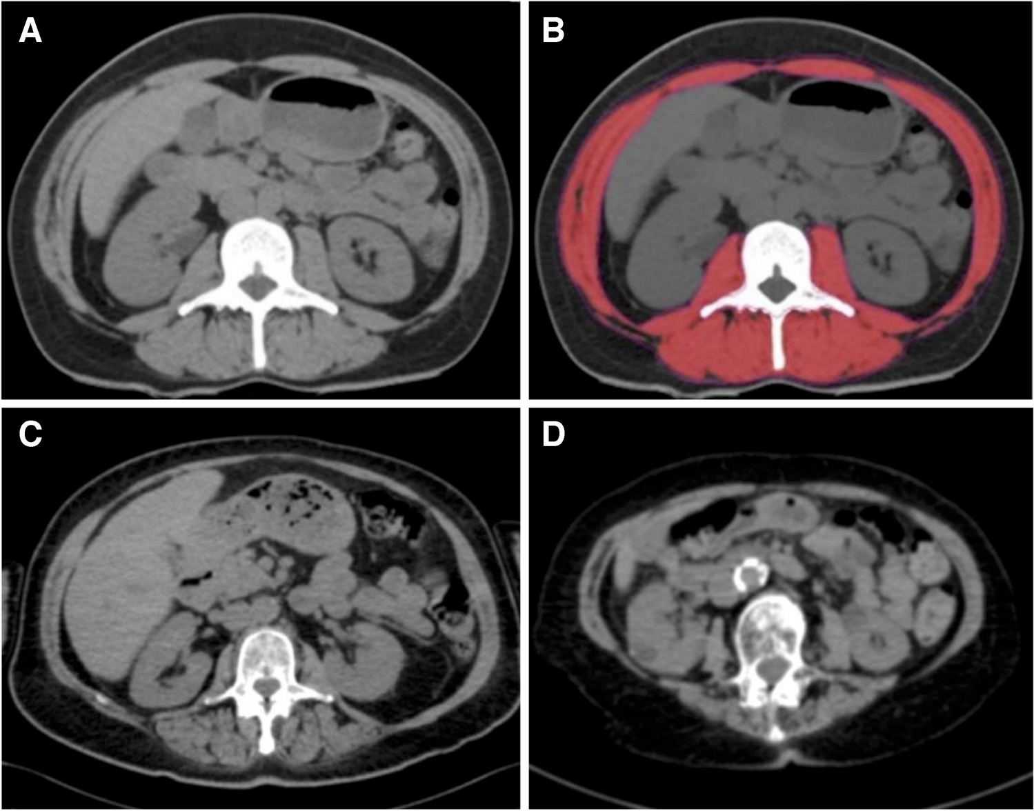 Myosteatosis in multiple myeloma: a key determinant of survival beyond sarcopenia
