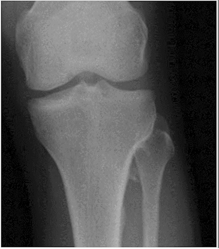 Test yourself question: Left knee pain in a young adult