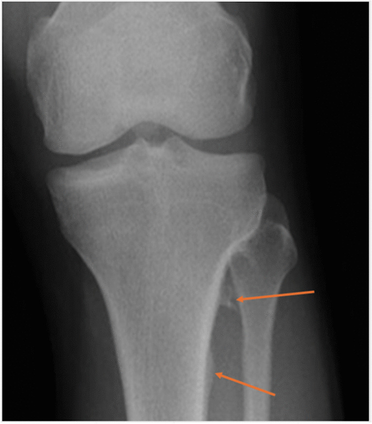 Test yourself answer: Left knee pain in a young adult