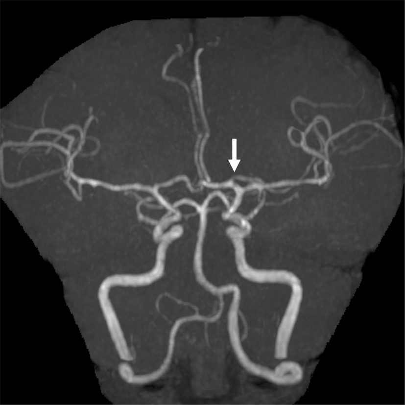Accessory middle cerebral artery associated with an accessory anterior cerebral artery