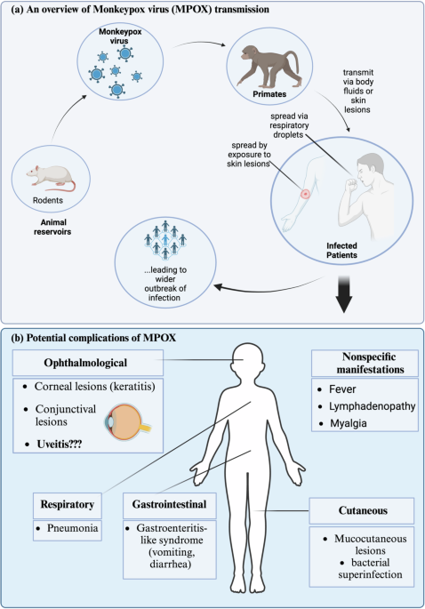 Monkeypox infection and risk for uveitis