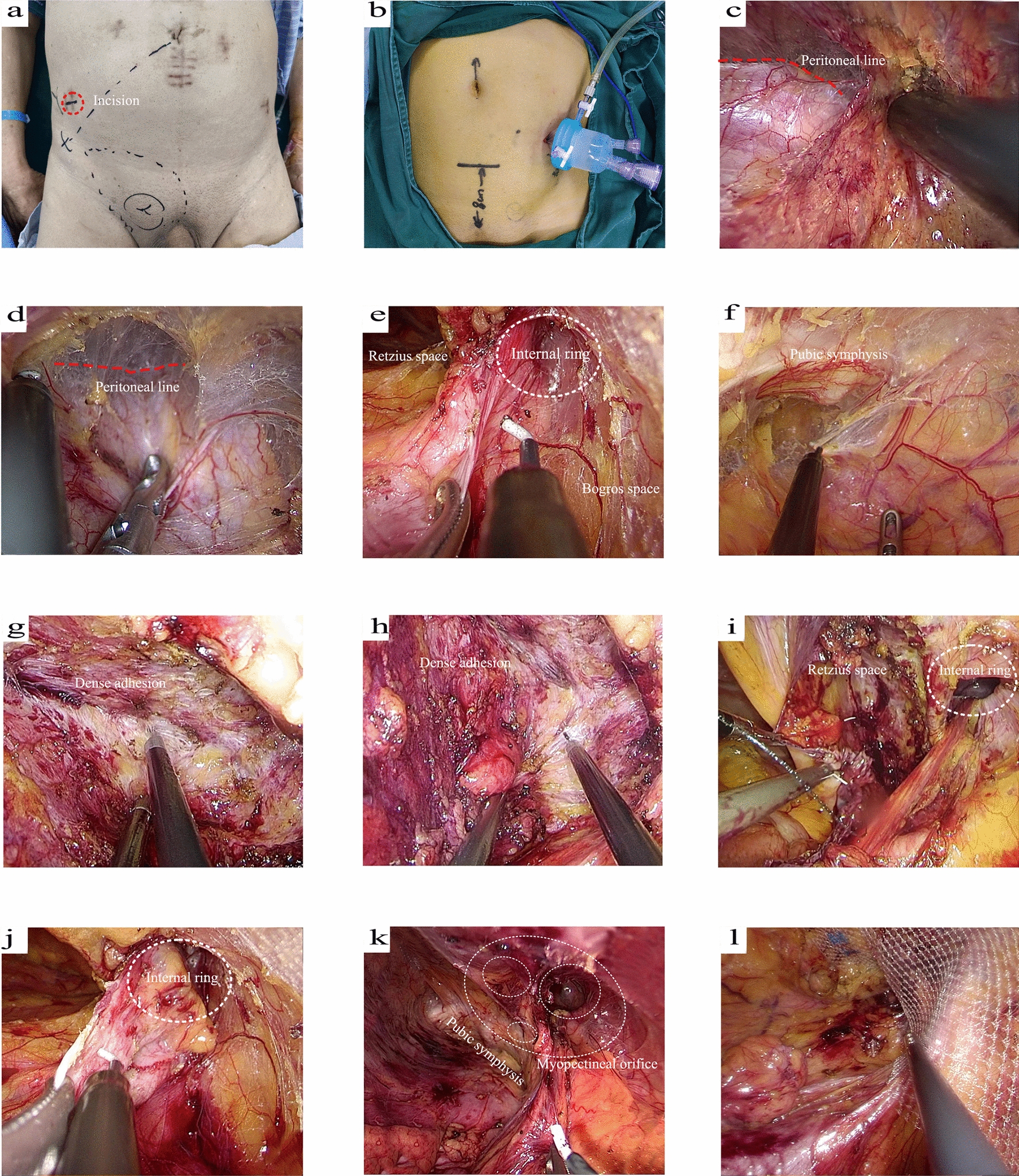 Preliminary experience in using the lateral single-incision laparoscopic totally extraperitoneal approach for inguinal hernia repair