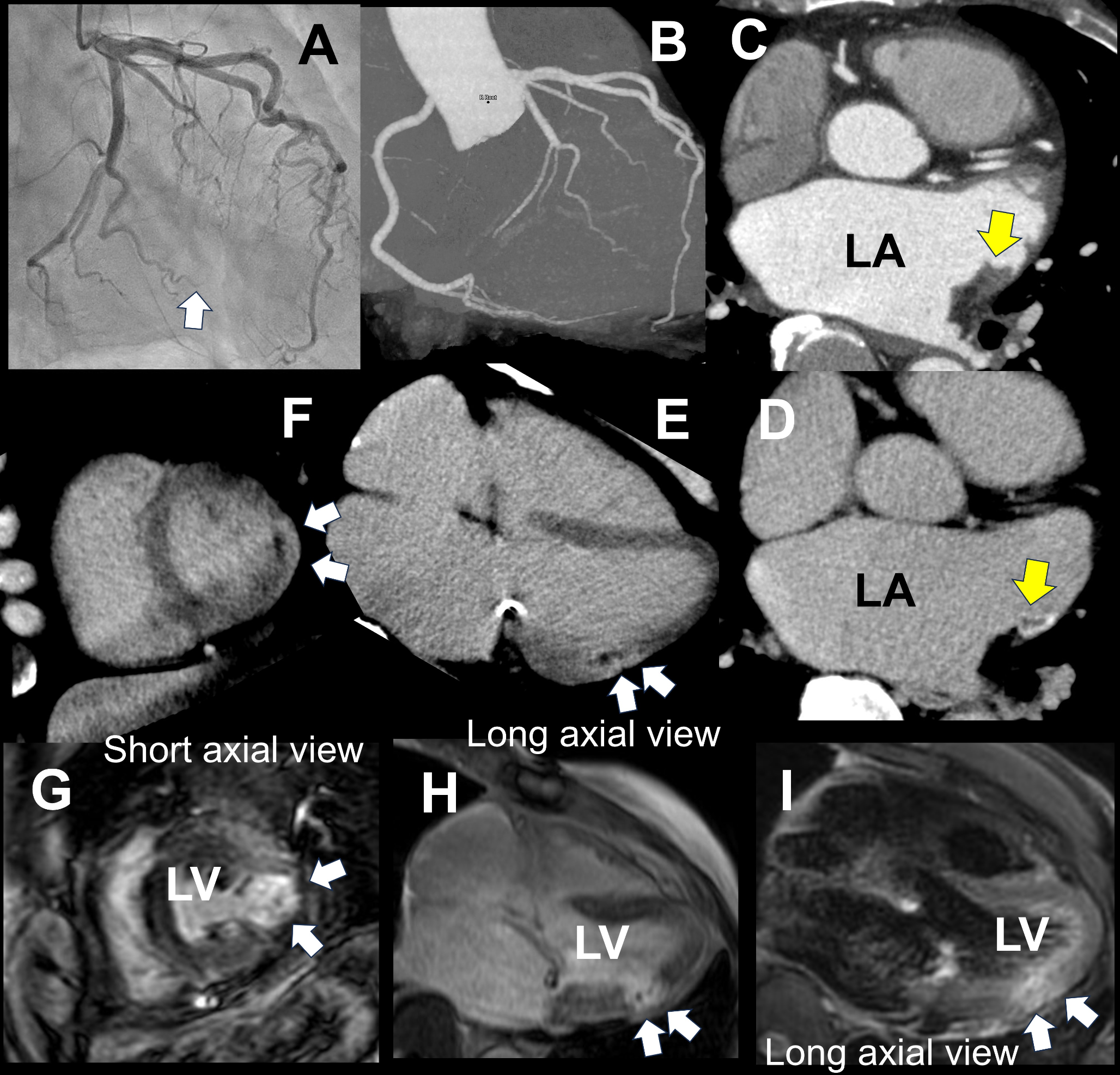 Computed tomography for diagnosis of tiny acute myocardial infarction with microvascular obstruction