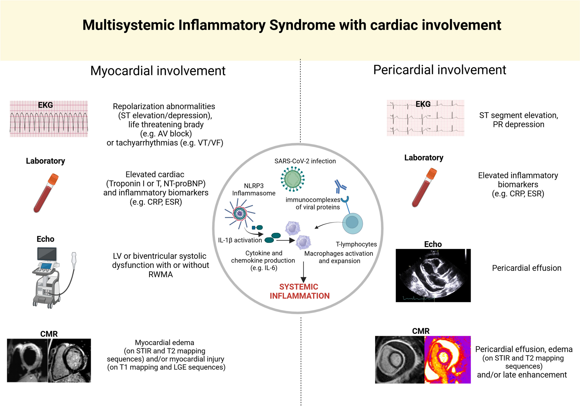 Inflammatory Heart Disease in Multisystem Inflammatory Syndrome