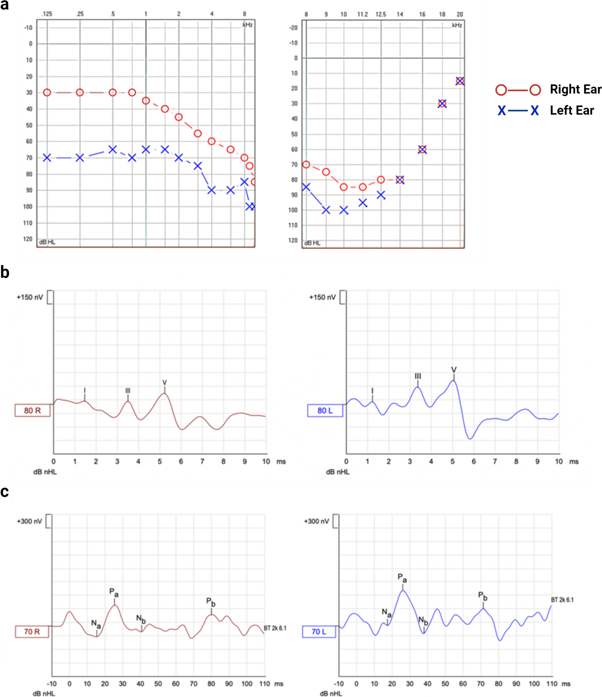A Neuron-Like Cellular Model for Severe Tinnitus Associated with Rare Variations in the ANK2 Gene