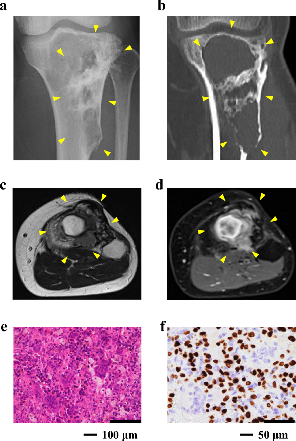 Establishment and characterization of NCC-GCTB10-C1: a novel cell line derived from a patient with recurrent giant cell tumor of bone