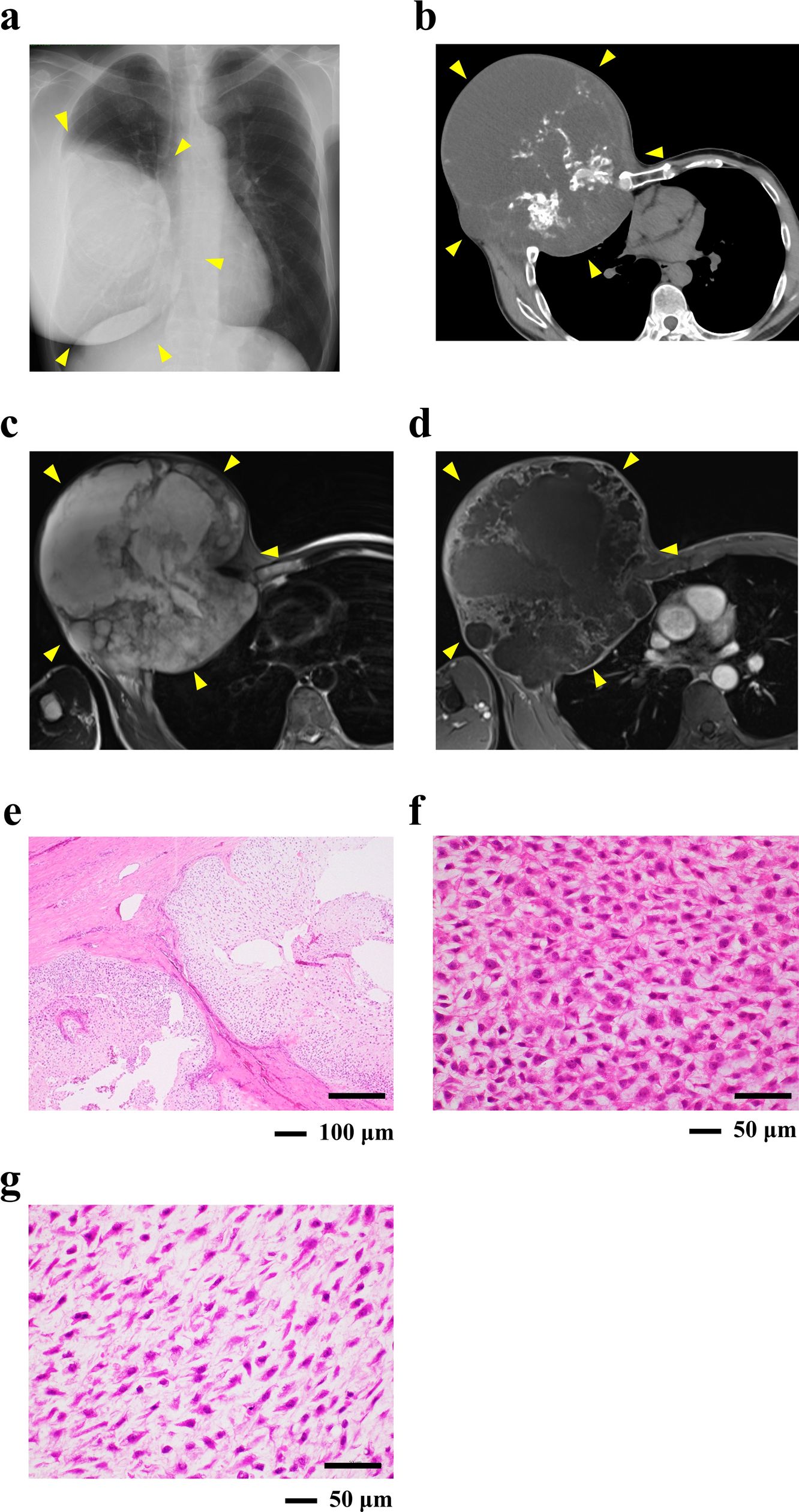 Establishment and characterization of a novel patient-derived cell line from conventional central grade 3 chondrosarcoma, NCC-CS1-C1