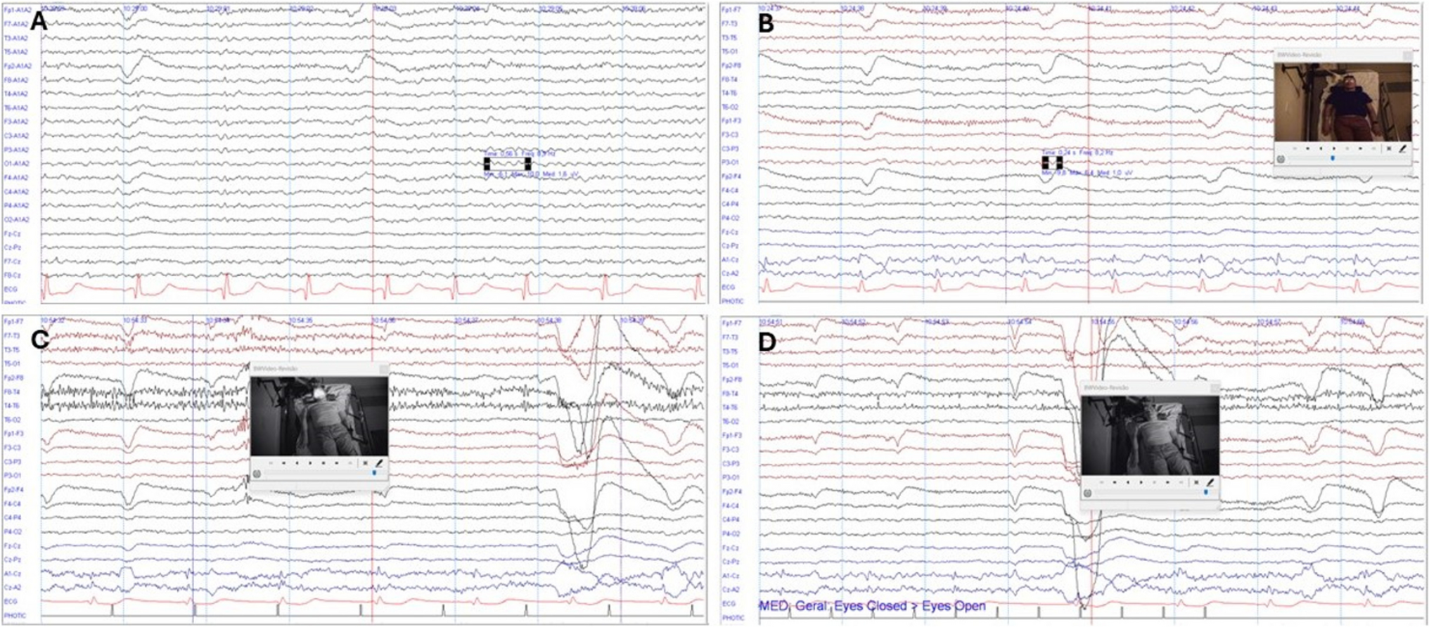 Neuronal ceroid lipofuscinosis 11 (CLN11) presenting with early-onset cone-rod dystrophy and learning difficulties