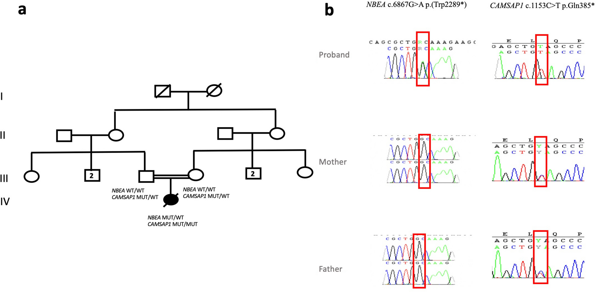 Brain malformation, neurodevelopmental disorder and epilepsy in a case of two rare genetic diseases: overlapping phenotype