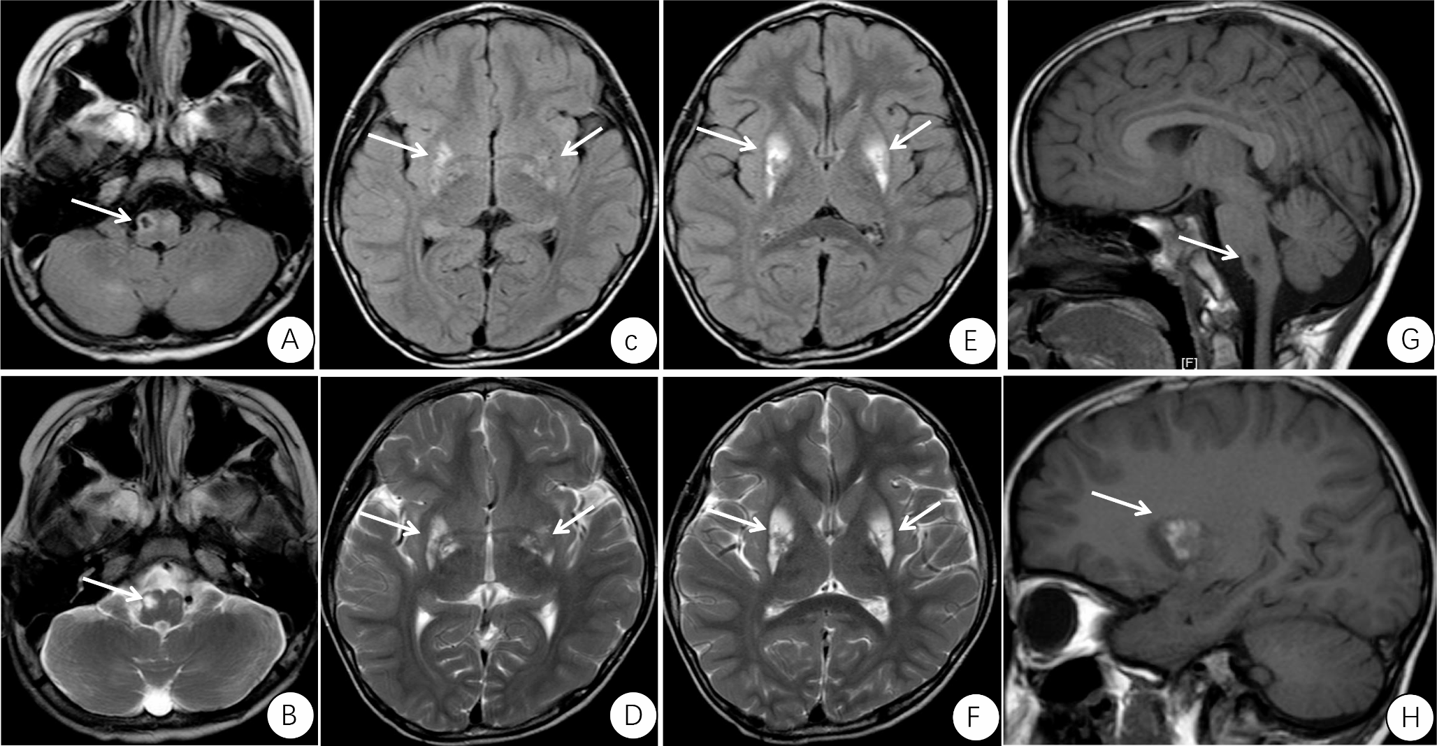 Identification of a novel pathogenic gene, NDUFA3, in Leigh Syndrome through whole exome sequencing