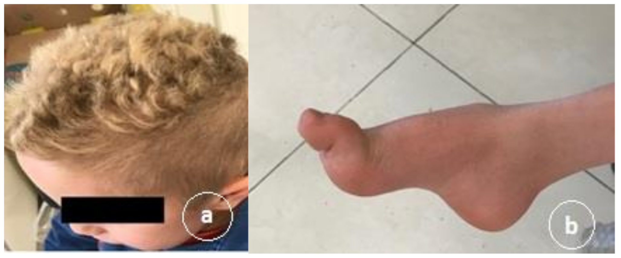 Giant axonal neuropathy: a rare inherited neuropathy with a novel mutation