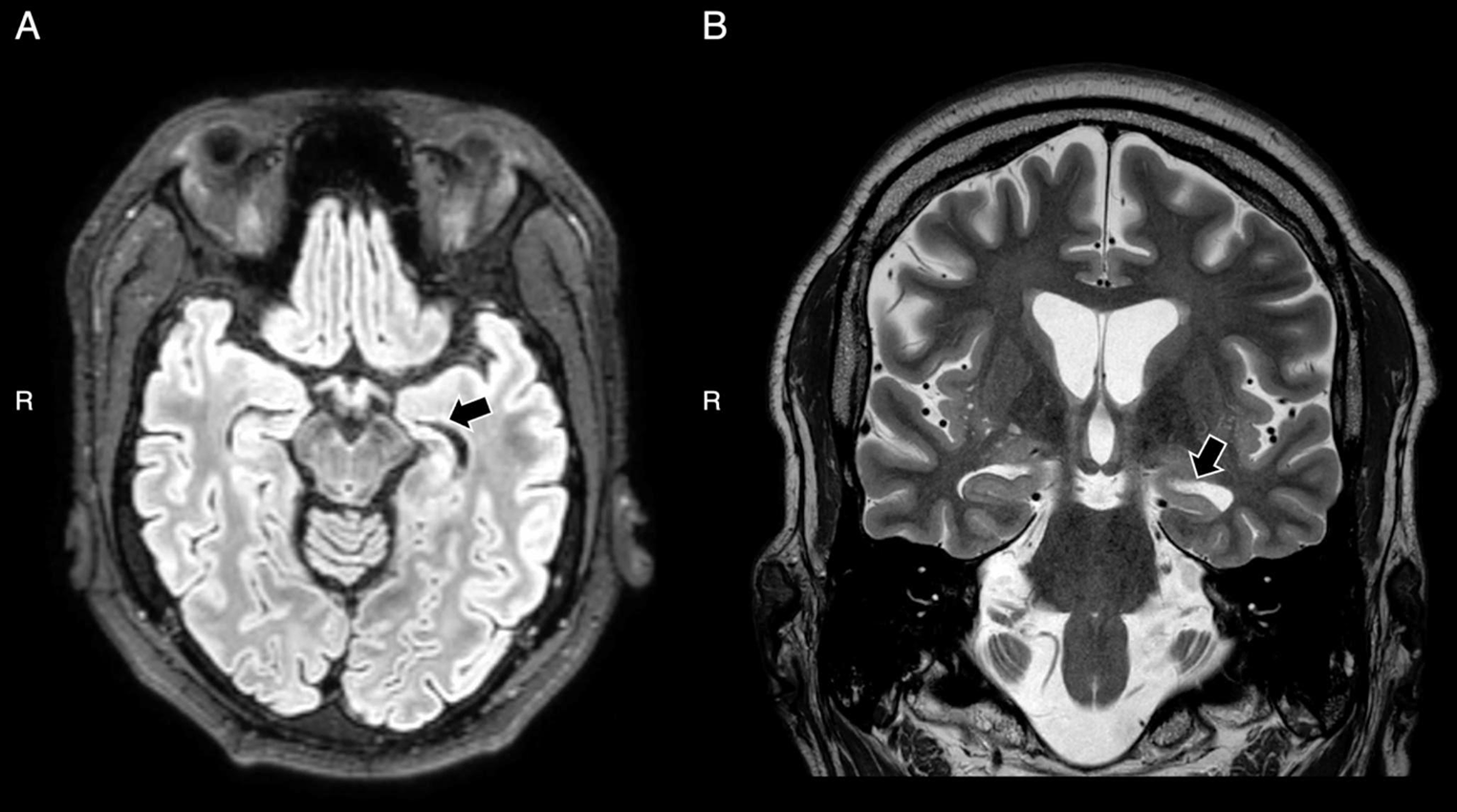 DHDDS-related epilepsy with hippocampal atrophy: a case report