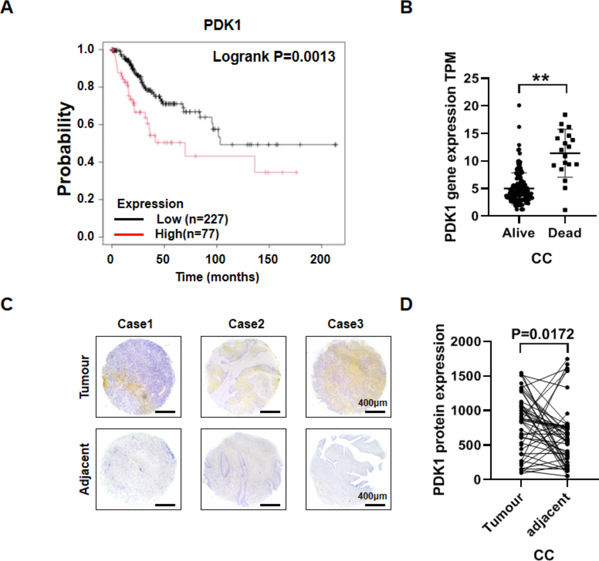 Activation of the WNT4/ β-catenin/FOXO1 pathway by PDK1 promotes cervical cancer metastasis and EMT process