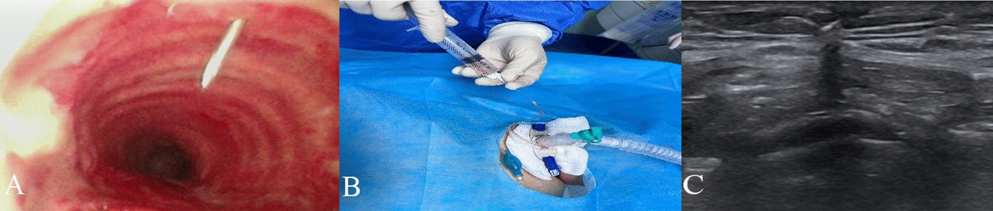 Safety Analysis of Visual Percutaneous Tracheostomy in Neurocritical Care Patients with Anticoagulation and Antithrombosis