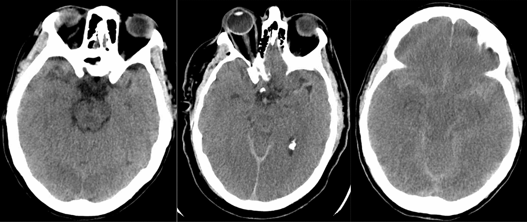 Neuroimaging Augments DCD-N Score in Predicting Time from Withdrawal of Life-Sustaining Measures to Death Among Potential Organ Donors