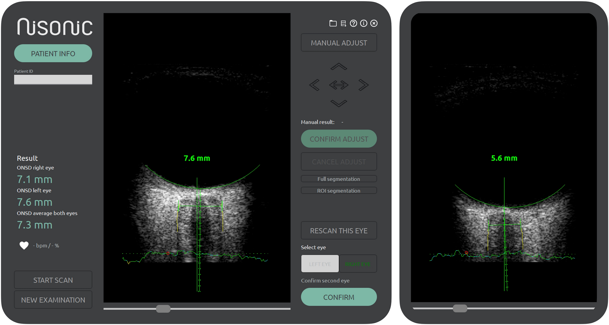 Real-Time Automated Measurements of Optic Nerve Sheath Diameter for Noninvasive Assessment of Intracranial Pressure in Aneurysmal Subarachnoid Hemorrhage