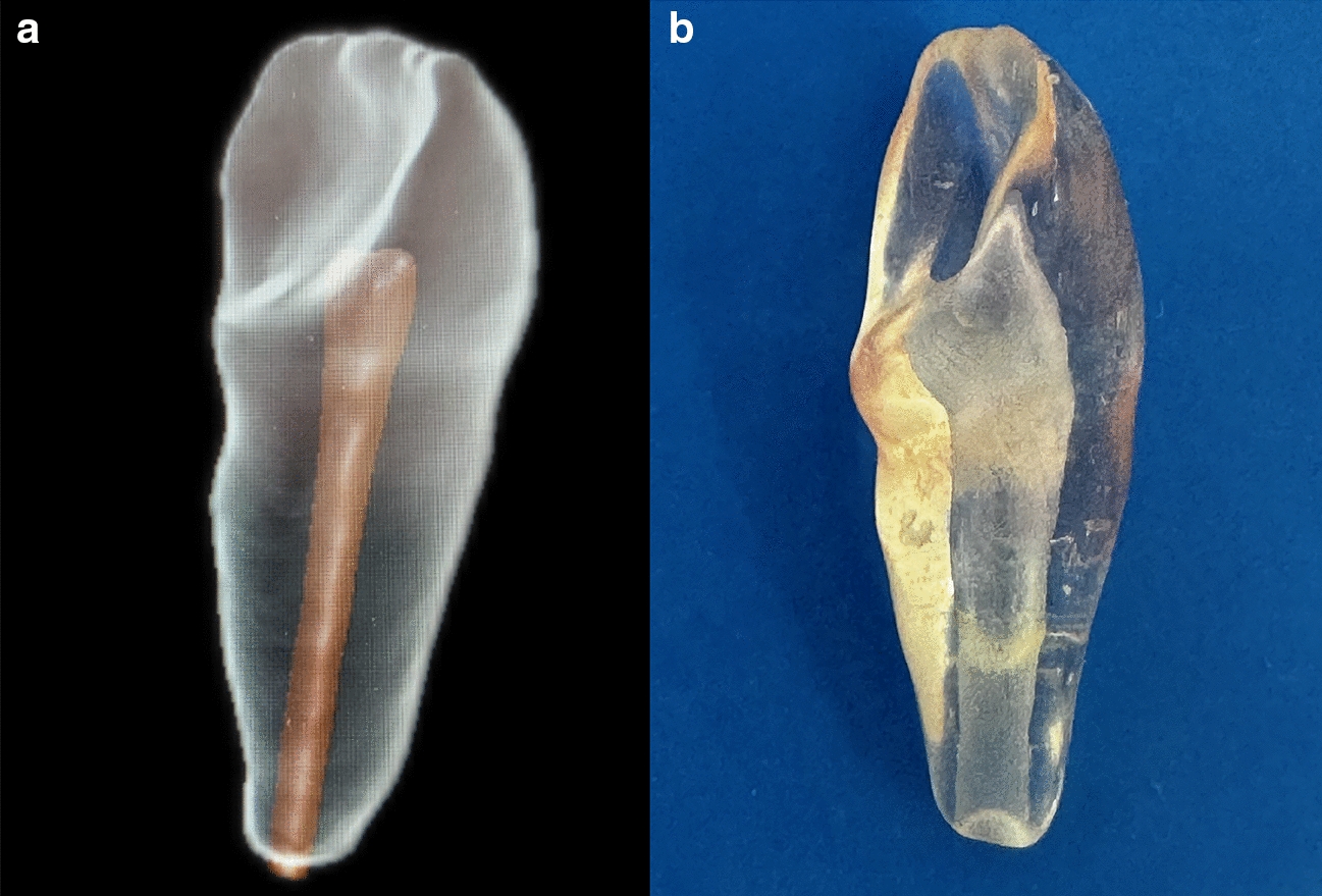 Assessment of apical extrusion in regenerative endodontics: a comparative study of different irrigation methods using three-dimensional immature tooth models