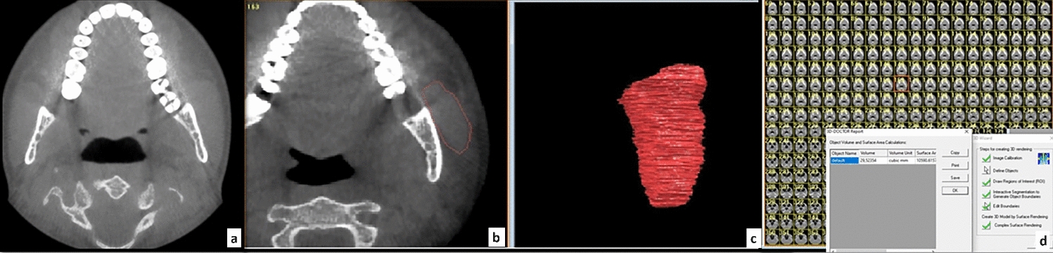 Assessing masseter muscle volume and activity in relation to craniofacial morphology: a 3D CBCT study