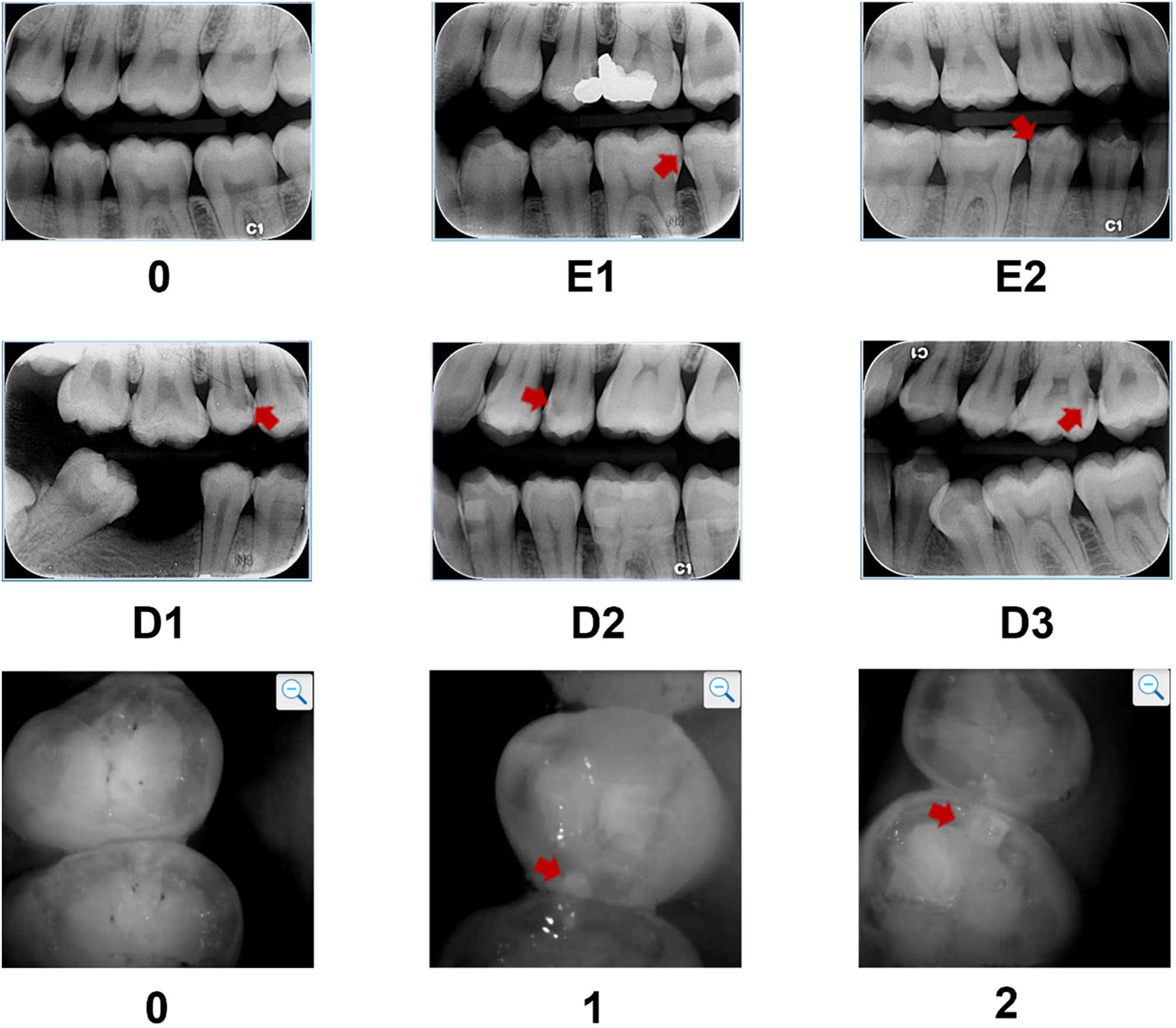 Near-infrared light reflection for the early detection of proximal caries in posterior teeth: an in vivo study