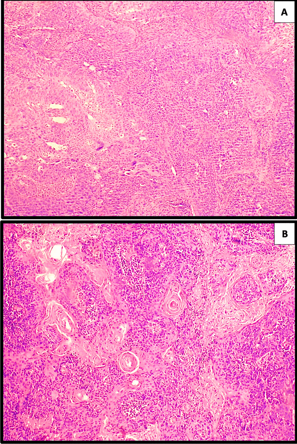 Study of Immunoexpression of Autophagy Markers- LC3A And LC3B in Cervical Squamous Cell Carcinoma and its Clinicopathological Correlation