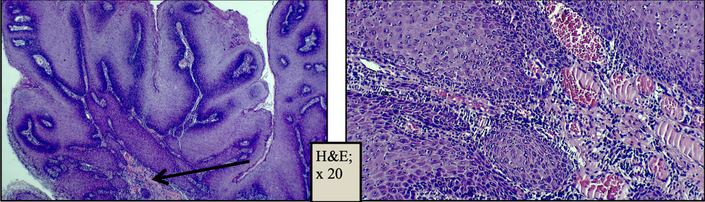 The Fate of Oral Cavity Verrucous Hyperplasia in a Diagnostic Biopsy: A Conundrum for Subsequent Management