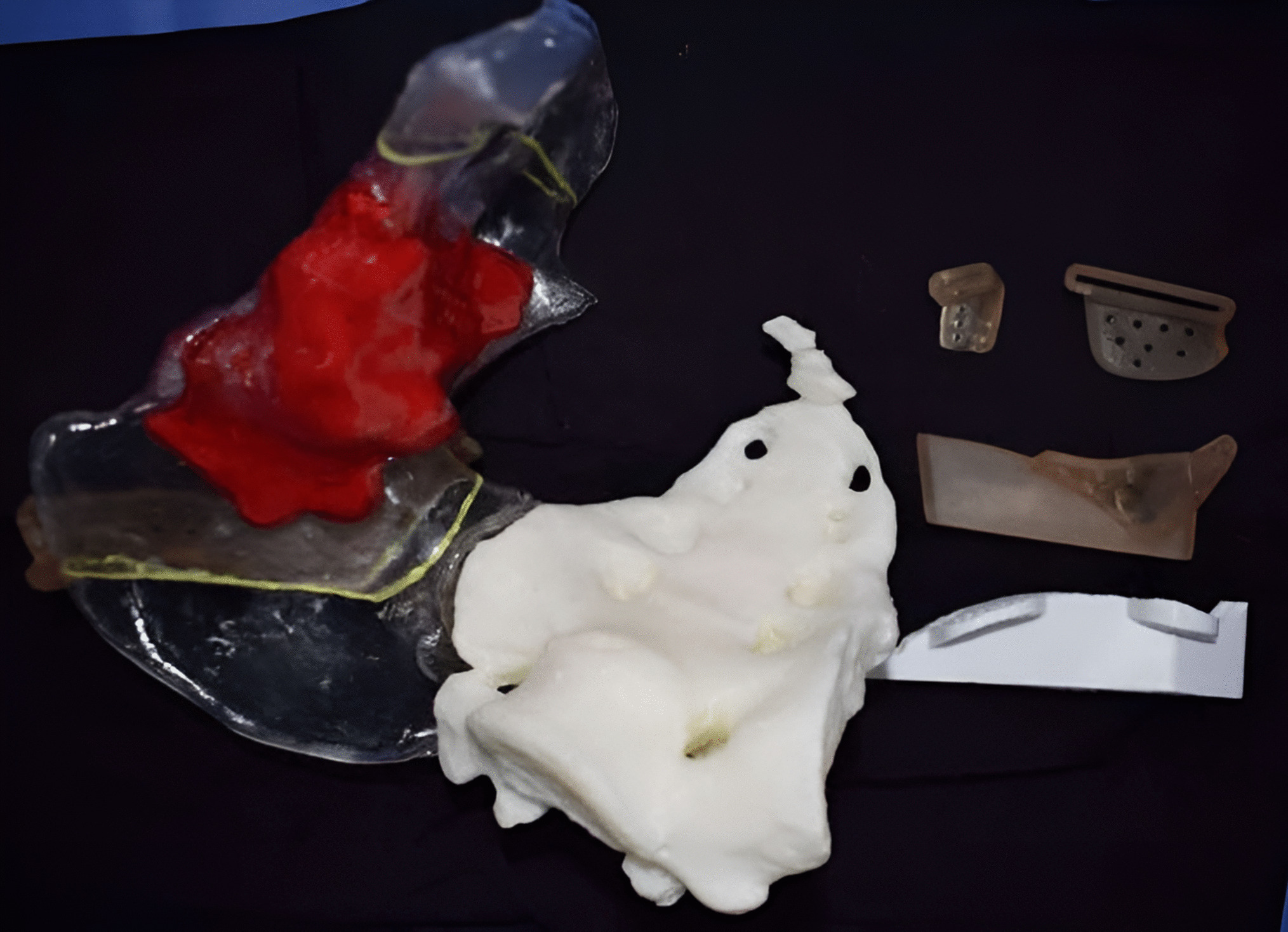 3D Printing in Orthopedic Oncology — Workflow and Outcomes of 59 Cases