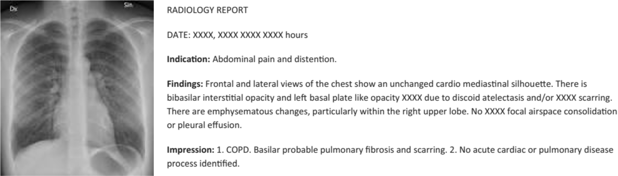 Engaging Preference Optimization Alignment in Large Language Model for Continual Radiology Report Generation: A Hybrid Approach