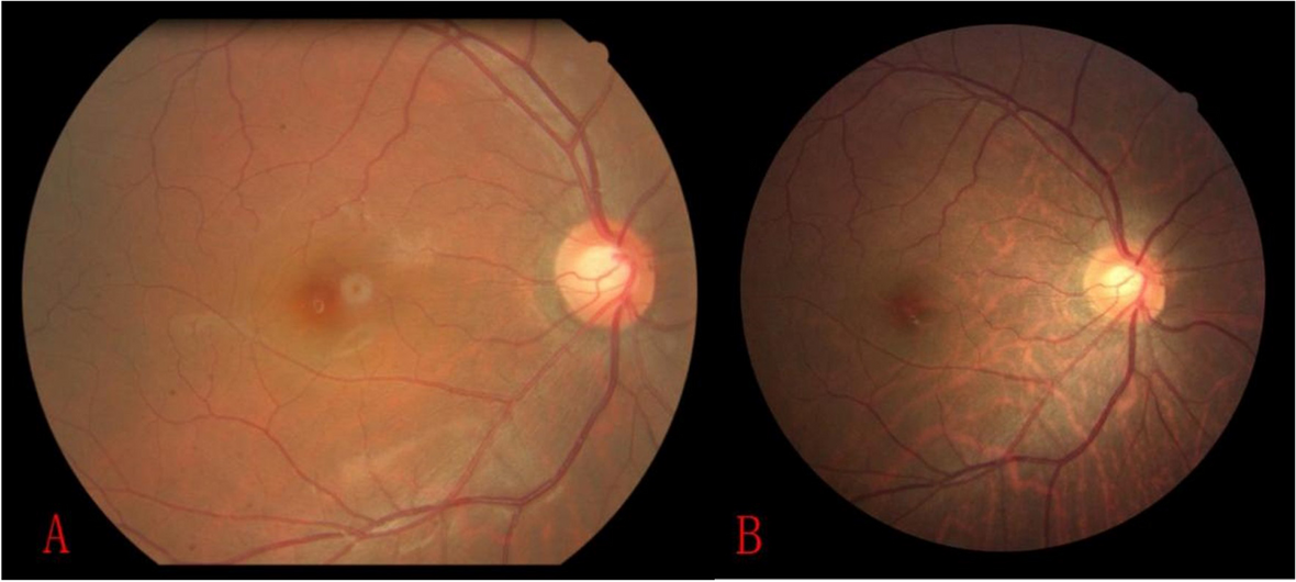 The prevalence and 6-year incidence of myopic tessellation in a Chinese rural adult population: the Handan Eye Study