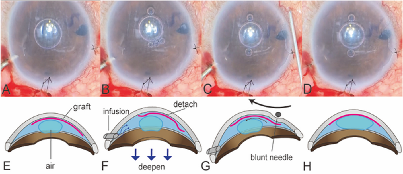 Graft-repositioning technique using infusion and small bubbles during Descemet’s membrane endothelial keratoplasty